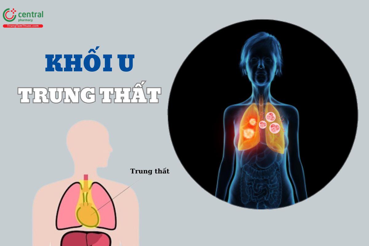 U trung thất ác tính sống được bao lâu? Triệu chứng và phương pháp điều trị