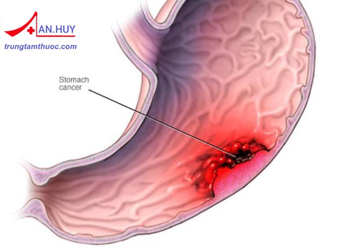 Những triệu chứng và nguyên nhân của bệnh ung thư dạ dày