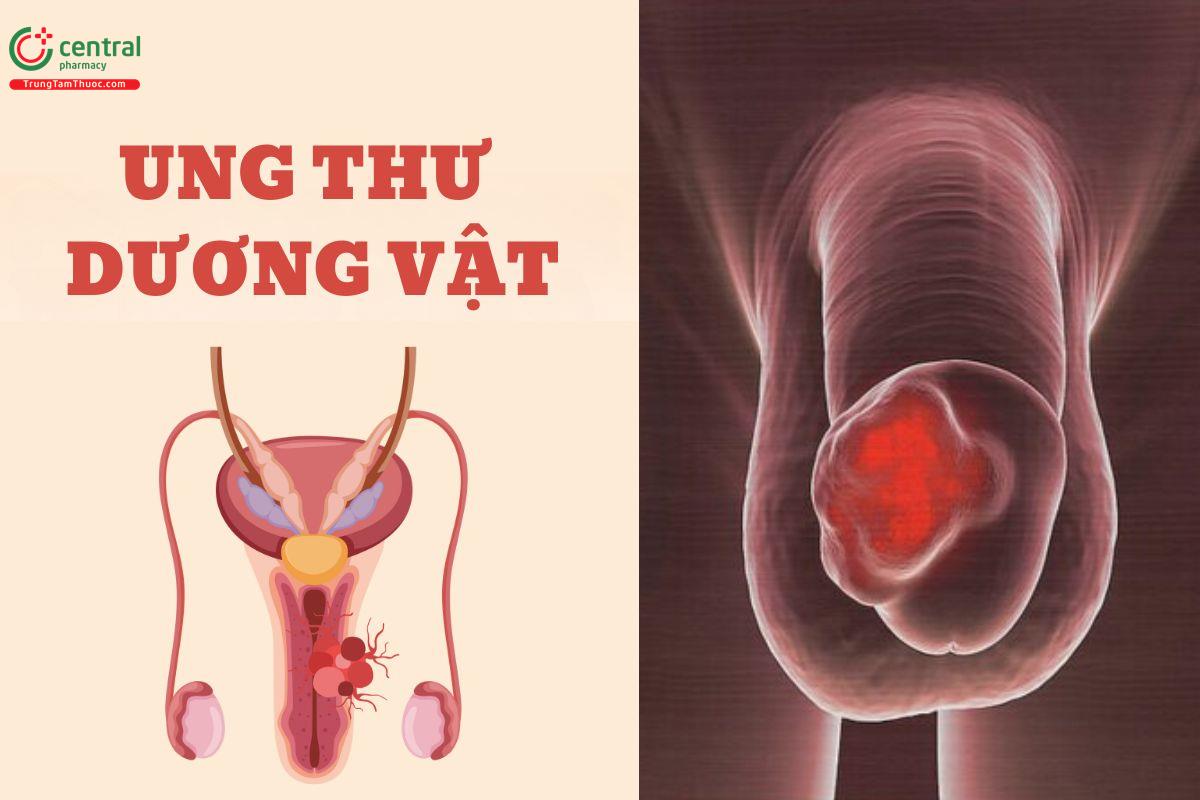 Ung thư dương vật có chết không? Hình ảnh và triệu chứng nhận biết giai đoạn đầu