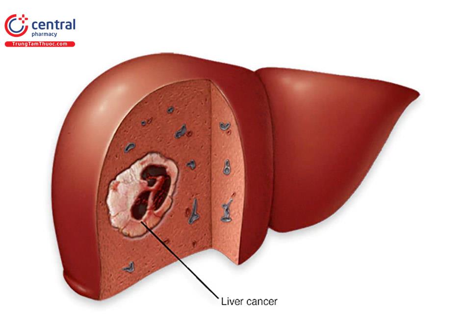 Ung thư gan: nguyên nhân, triệu chứng và điều trị bệnh