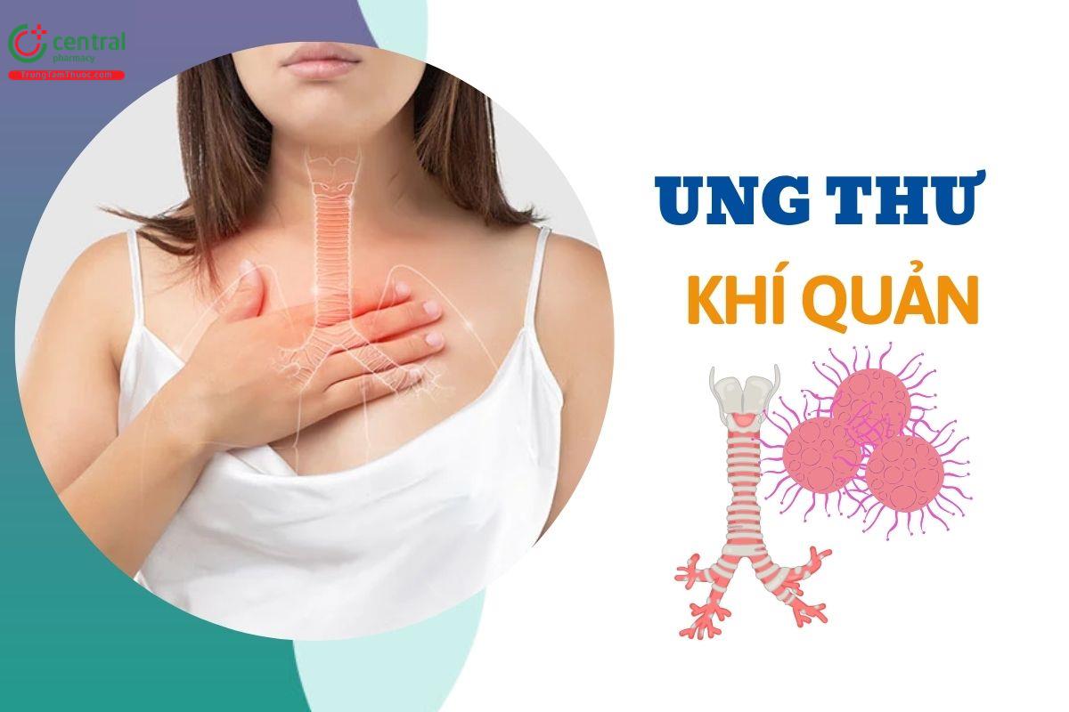 Ung thư khí quản là gì? Sống được bao lâu? Nguyên nhân và triệu chứng bệnh