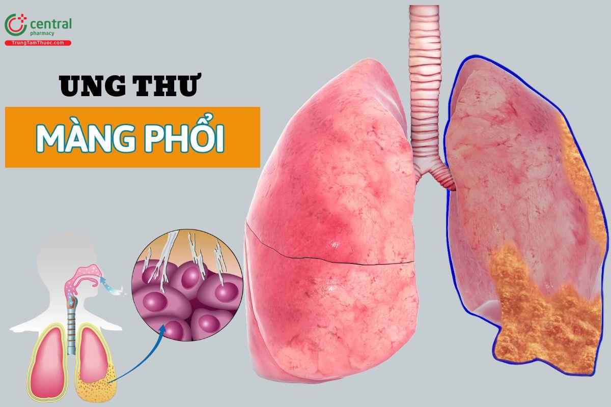 Ung thư màng phổi có nguy hiểm không? Nguyên nhân và cách điều trị