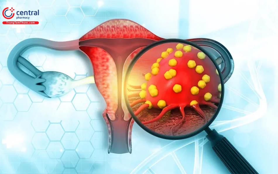 Quá trình tiến triển của tế bào gây ung thư niêm mạc tử cung ở phụ nữ