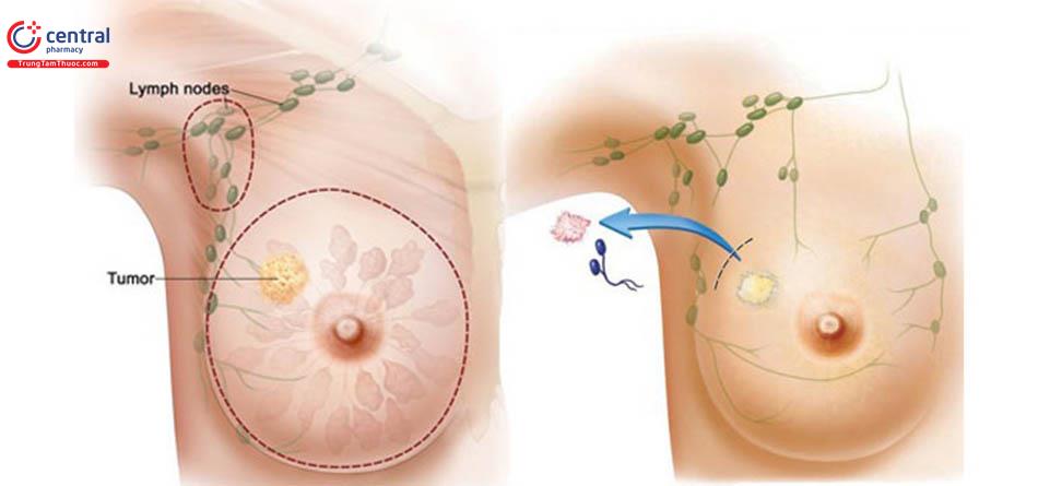 Ung thư vú: Dấu hiệu nhận biết sớm nhất, phương pháp điều trị