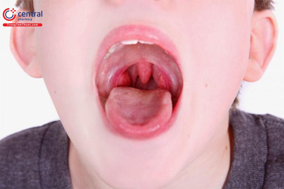 Viêm amidan ở trẻ em: nguyên nhân, triệu chứng, điều trị 