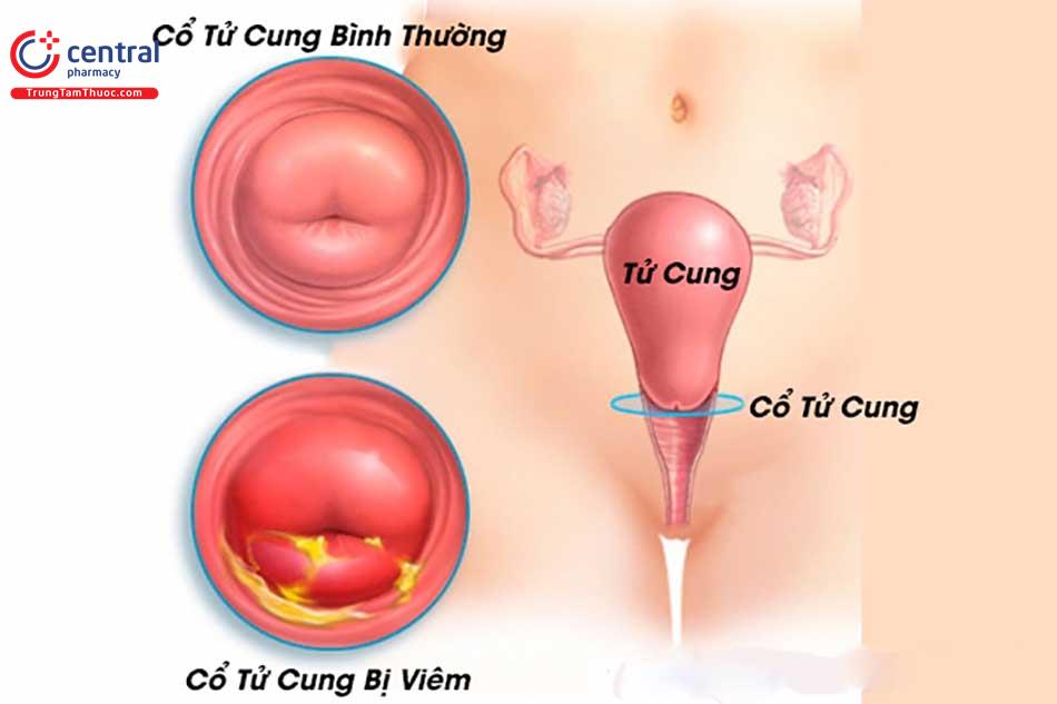 Viêm cổ tử cung: nguyên nhân, triệu chứng và cách điều trị