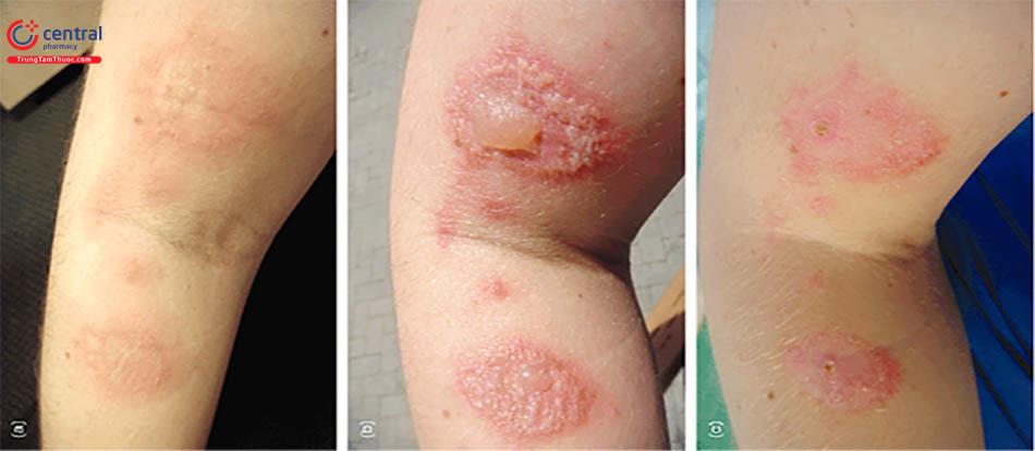 Viêm da tiếp xúc do côn trùng: cách phòng tránh và điều trị