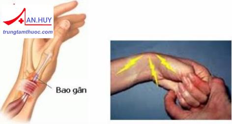 VIÊM ĐIỂM BÁM GÂN VÀ MÔ MỀM QUANH KHỚP: CHẨN ĐOÁN VÀ ĐIỀU TRỊ