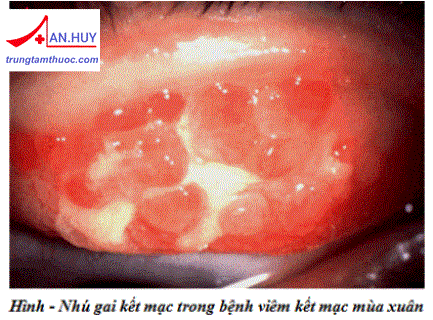Bệnh viêm kết mạc mùa xuân: nguyên nhân và cách điều trị