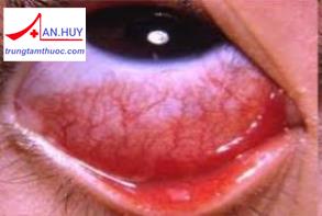 Bệnh viêm kết mạc dị ứng cấp tính và cách điều trị