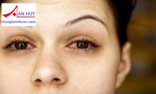 Viêm kết mạc dị ứng: nguyên nhân, triệu chứng và cách điều trị