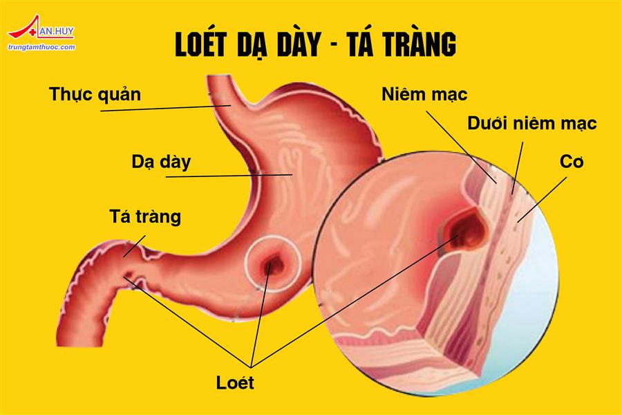 CÁC THUỐC ĐIỀU TRỊ BỆNH LOÉT DẠ DÀY - TÁ TRÀNG