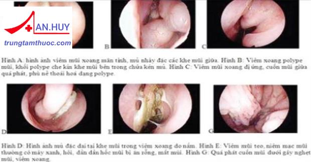 VIÊM MŨI CẤP: TRIỆU CHỨNG, NGUYÊN NHÂN VÀ ĐIỀU TRỊ