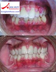 Bệnh viêm nướu triển dưỡng: chẩn đoán và điều trị
