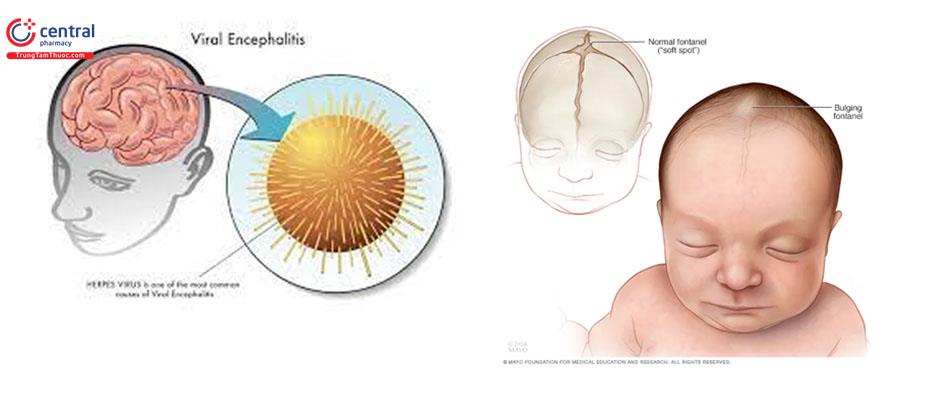 Viêm não cấp ở trẻ em: phương pháp chẩn đoán và điều trị