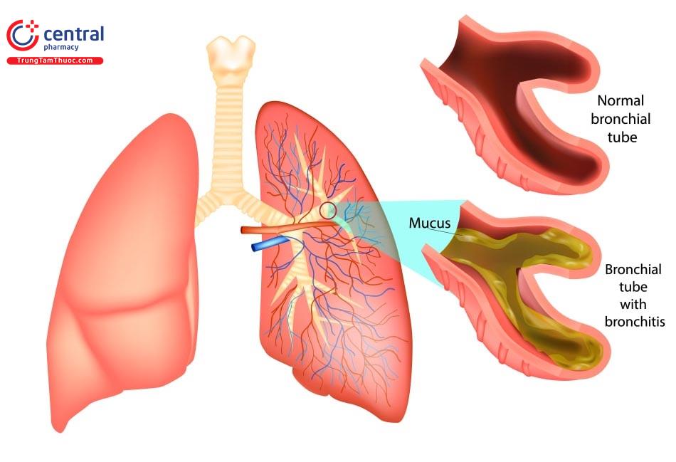 Viêm phế quản cấp: nguyên nhân, triệu chứng và phác đồ điều trị