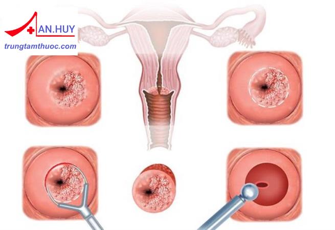 Viêm cổ tử cung: Chẩn đoán và điều trị như thế nào?