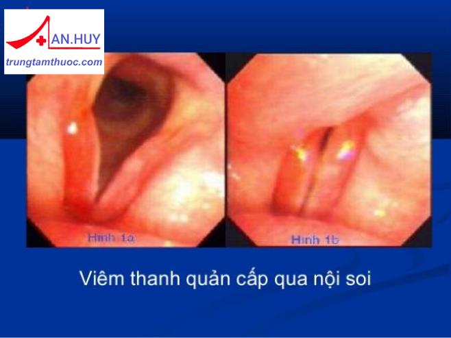 VIÊM THANH QUẢN CẤP Ở TRẺ EM: TRIỆU CHỨNG VÀ ĐIỀU TRỊ