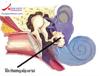 BỆNH XỐP XƠ TAI: TRIỆU CHỨNG, CHẨN ĐOÁN VÀ ĐIỀU TRỊ