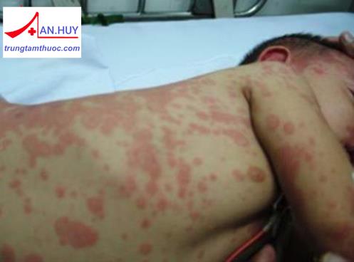 ĐIỀU TRỊ XUẤT HUYẾT GIẢM TIỂU CẦU NGUYÊN PHÁT Ở TRẺ EM