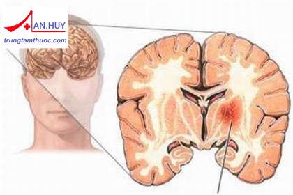 Quy trình chẩn đoán và điều trị chấn thương sọ não