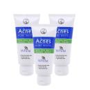 sua rua mat acnes pure white 1 G2011 130x130px