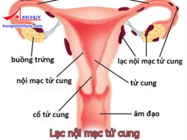Lạc nội mạc tử cung