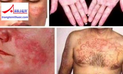 lupus ban đỏ hệ thống
