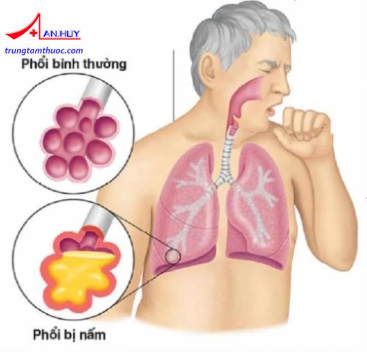 Điều trị nấm phổi thế nào?