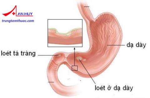 xuất huyết tiêu hóa