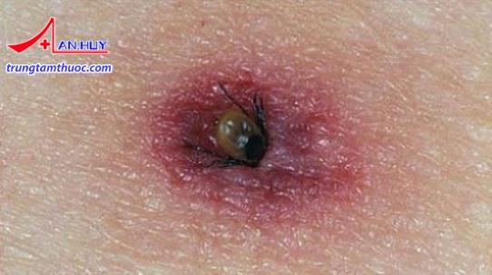 Bọ ve đốt gây bệnh Lyme