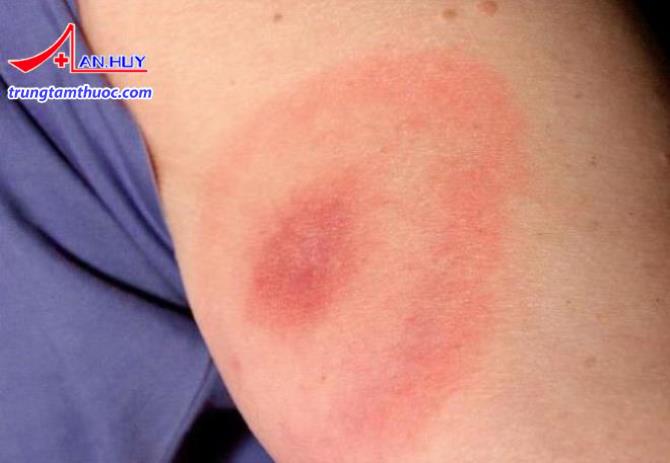 Giai đoạn sớm của bệnh Lyme
