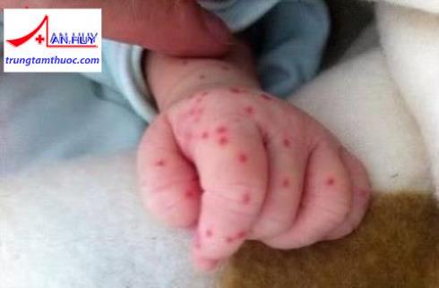 Xuất huyết giảm tiểu cầu ở trẻ em