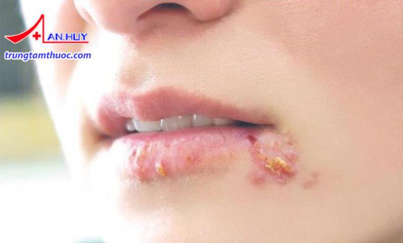 Hình ảnh người mắc bệnh giang mai