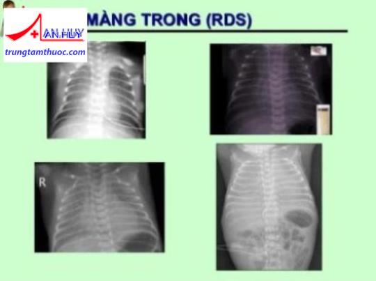 bệnh màng trong