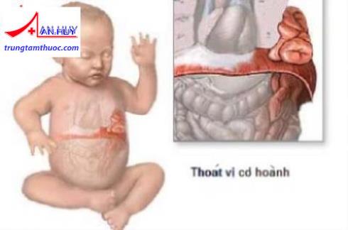 thoát vị cơ hoành