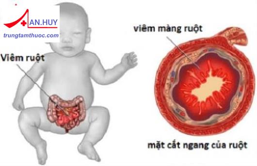 viêm hoại tử ruột non