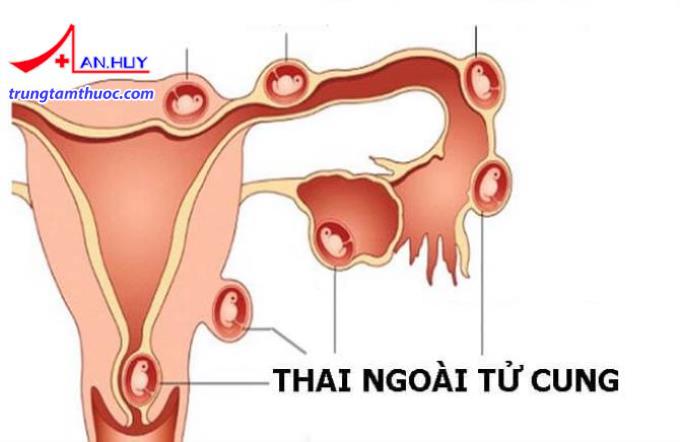 Vị trí thai nằm ngoài tử cung