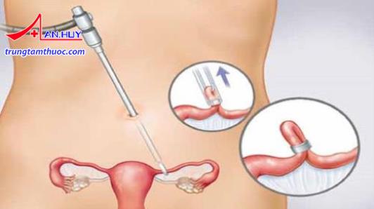 Thắt ống dẫn trứng làm tăng nguy cơ mang thai ngoài tử cung