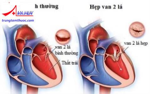 Hẹp van 2 lá