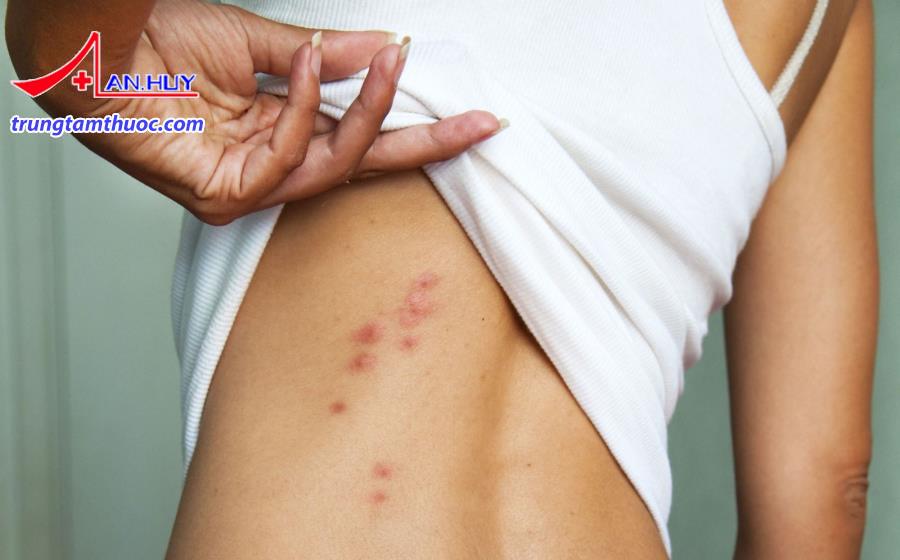 Dị ứng do côn trùng đốt