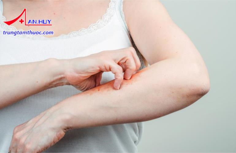 Da nổi mẩn và ngứa khi bị côn trùng đốt