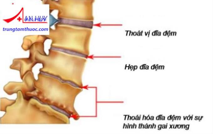 Thoái háo cột sống