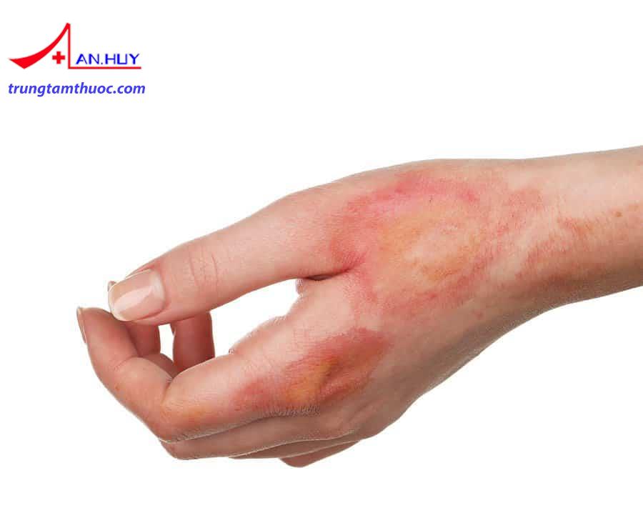 Triệu chứng của hội chứng Lyell