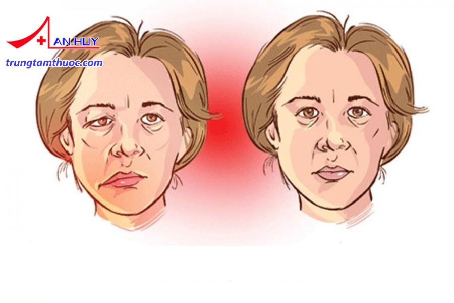 Người bệnh nhược cơ bị yếu cơ mặt với biểu hiện đặc trưng.