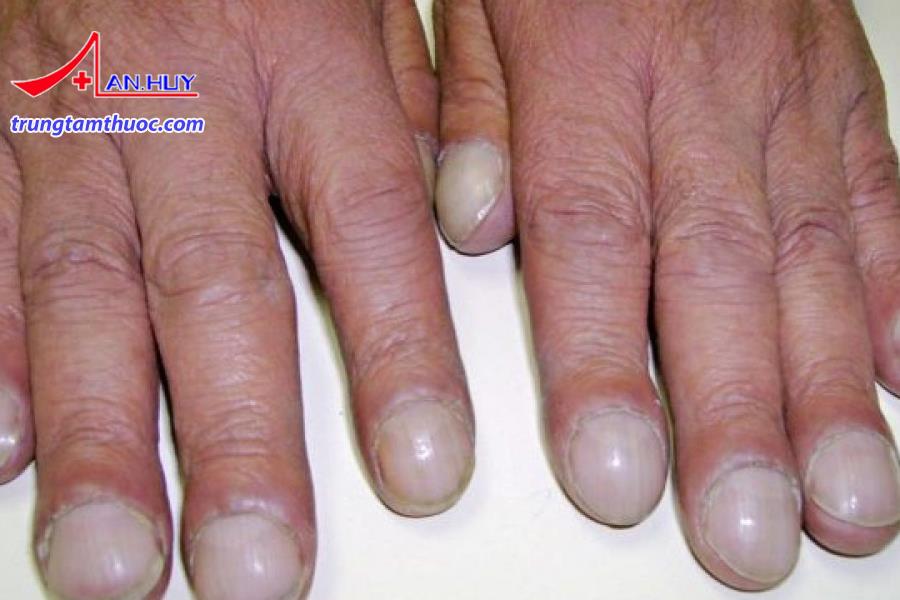 Triệu chứng của người bệnh to đầu chi.