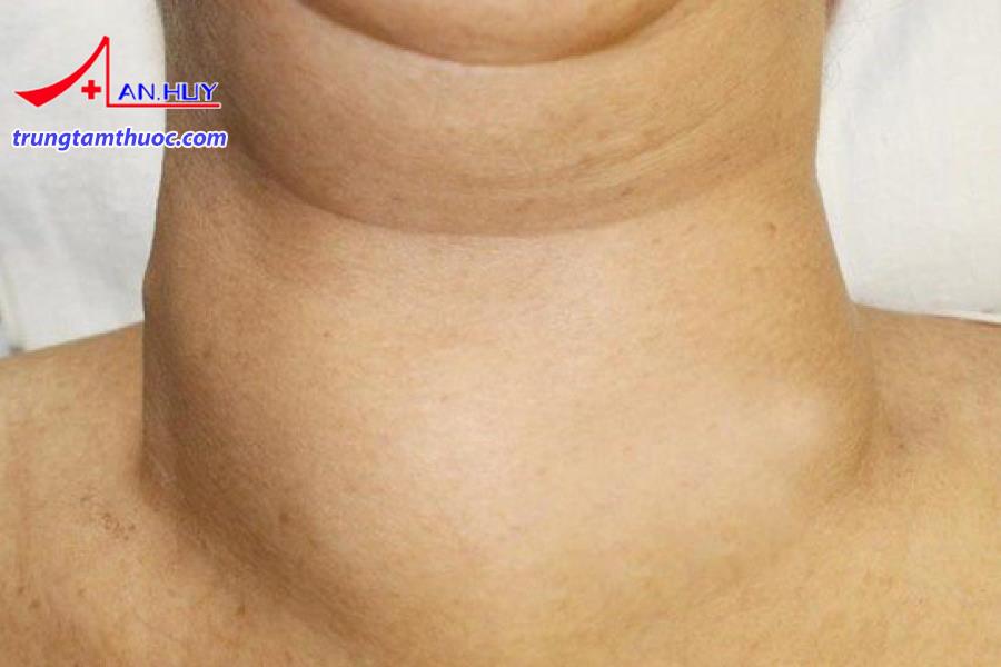 Bướu giáp đơn thuần là gì?