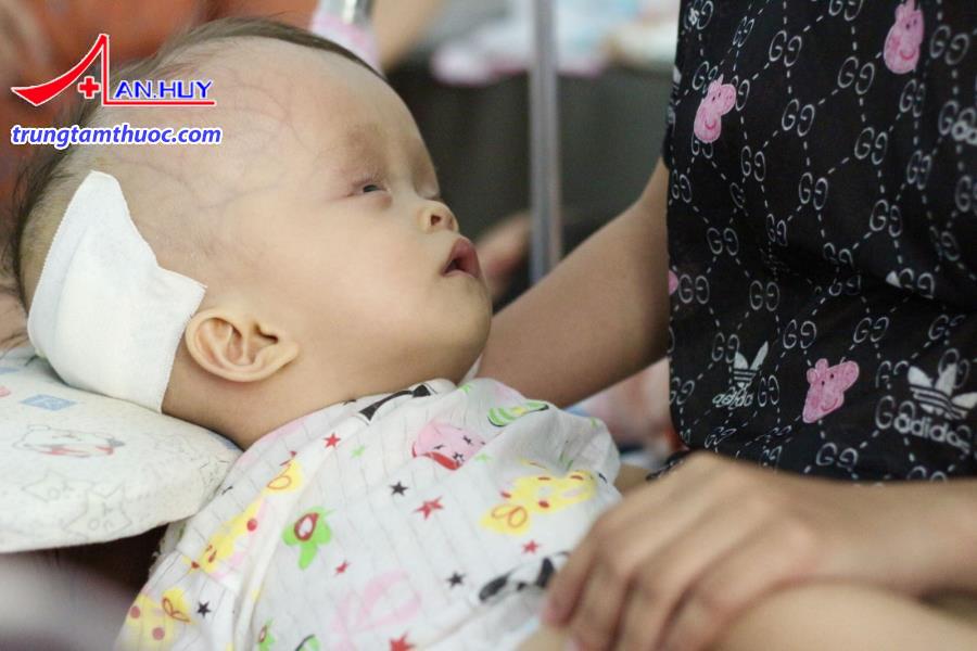 Não úng thủy gây nhiều biến chứng nguy hiểm.