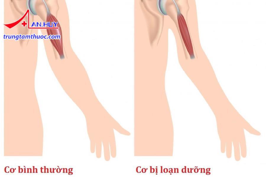 Loạn dưỡng cơ là gì?