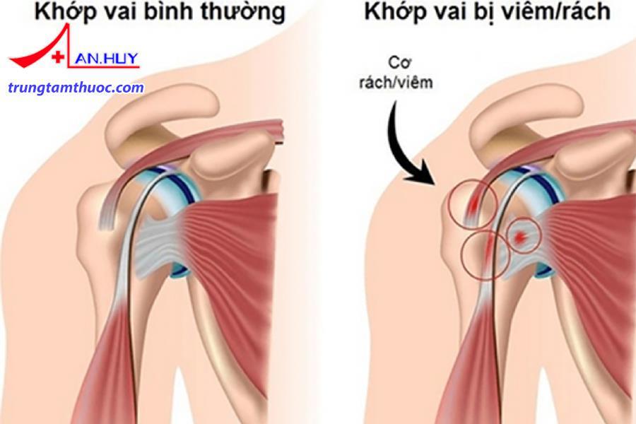 Viêm quanh khớp vai là gì?